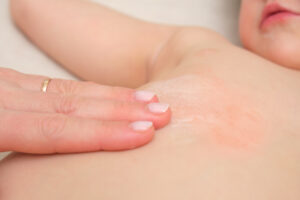 これでもう悩まない！汗っかきな子どものためのあせも対策講座